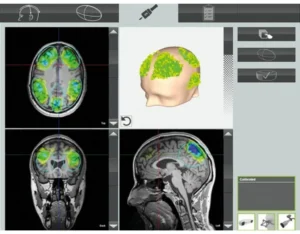 ภาพการรักษาโรคสมองเสื่อม